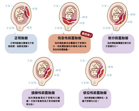 前置胎盤改善